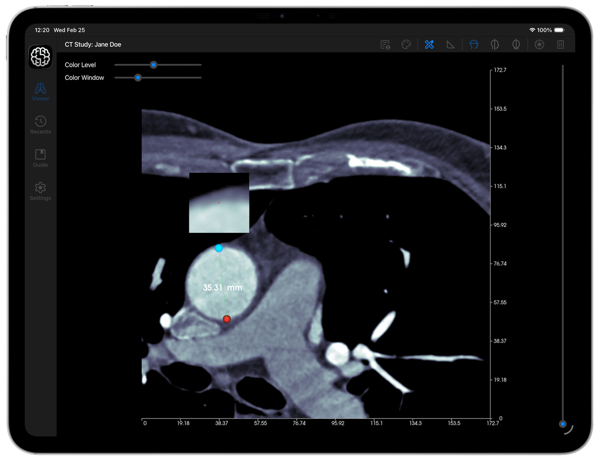 DICOM Studio Go: Distance Tool on iPad