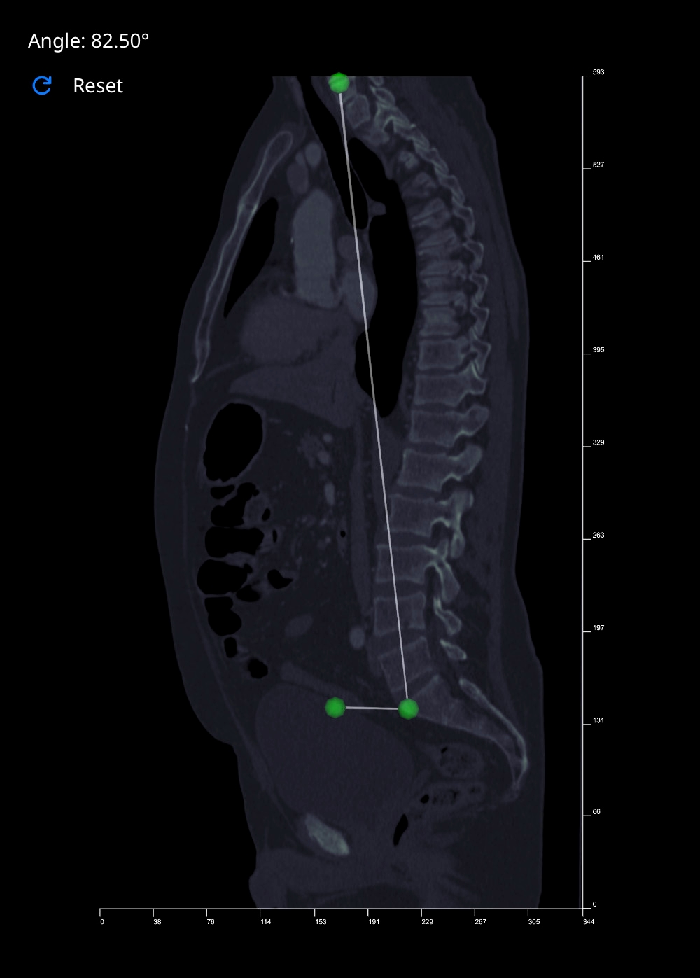 Spinal Tilt angle measurement in Vista