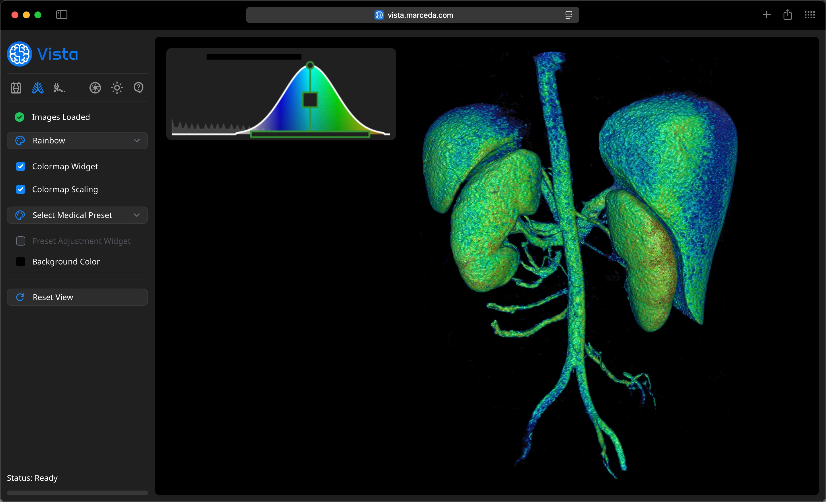 Volume Render of Renal MRA on Vista