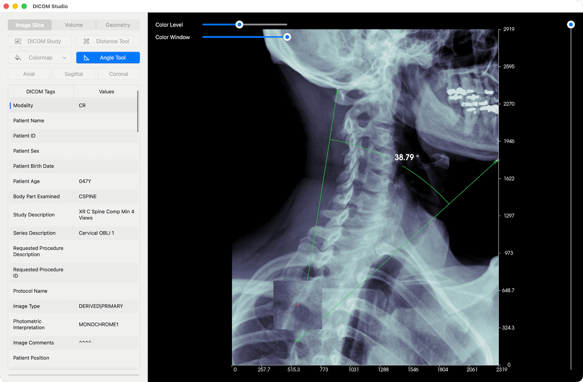 Angle Tool - DICOM Studio