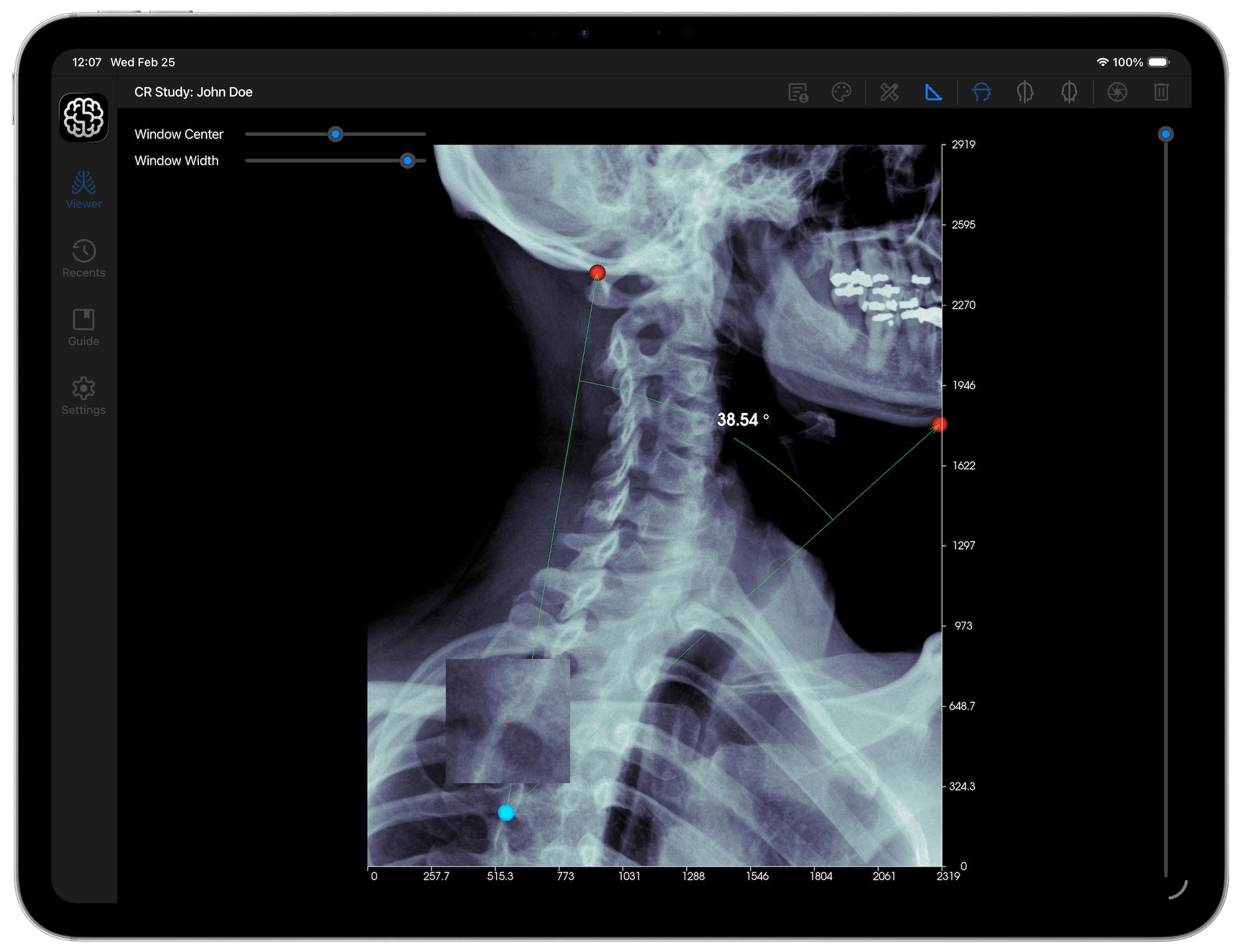 DICOM Studio Go on iPad - Angle Tool
